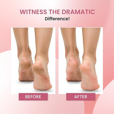 UrbanYog Callus Remover