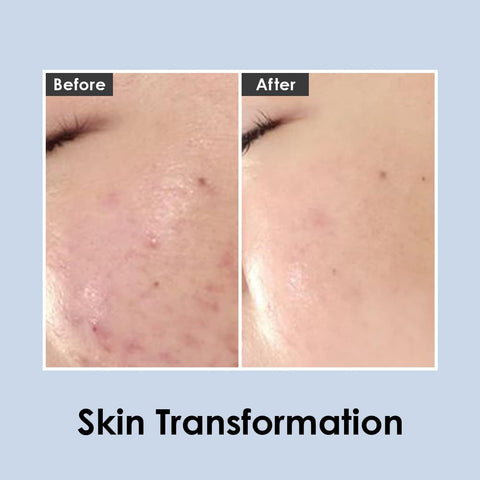 MEDI-PEEL Centella Mezzo Cream, 30ml | Spot Cream for Skin Breakouts